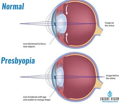 Presbyopia_1